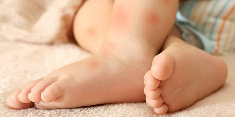 Blog Grossesse Prevention Et Traitement Des Piqures De Moustiques Chez Les Bebes Et Les Enfants En Bas Age