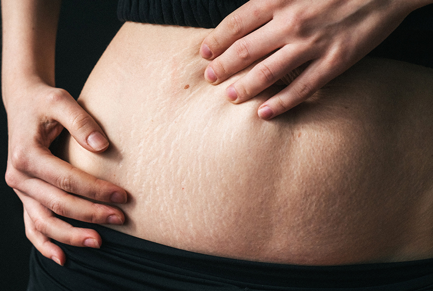 Schwangerschaftsstreifen am Bauch Nahaufnahme einer schwangeren Frau, die mit der Hand ihre Bauchhaut berührt, auf der sich erste Schwangerschaftsstreifen zeigen.