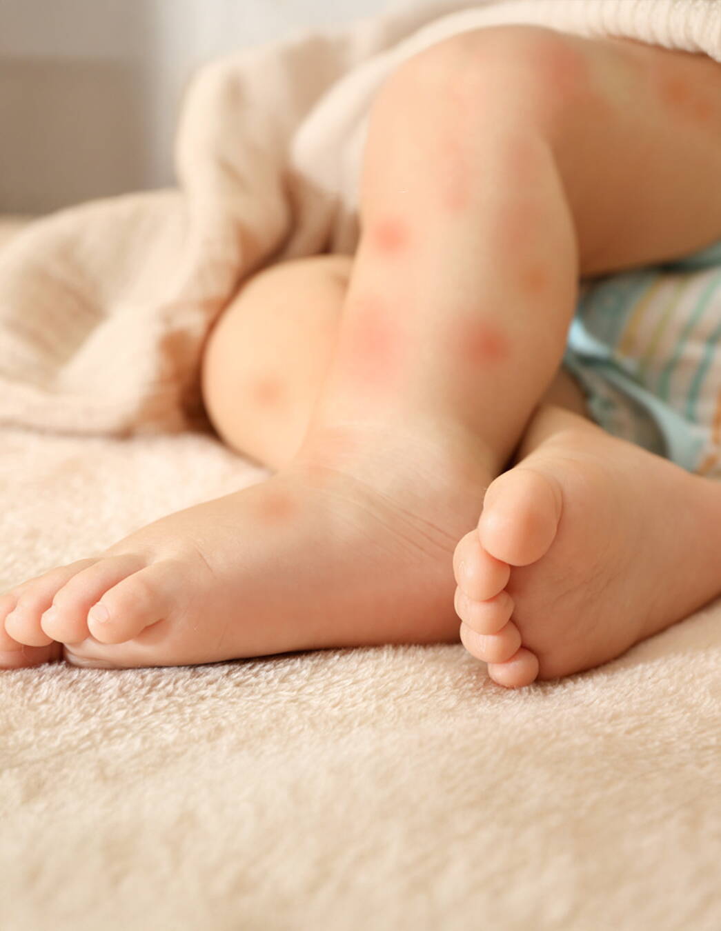 Le punture di zanzara possono rendere la vita difficile ai neonati e ai bambini piccoli. Scoprite qui come prevenirle e alleviare delicatamente i fastidi

