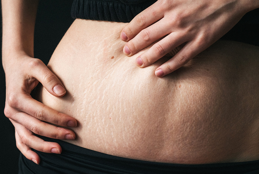 Schwangerschaftsstreifen am Bauch Nahaufnahme einer schwangeren Frau, die ihre noch zarte Bauchhaut mit ersten Schwangerschaftsstreifen pflegt.