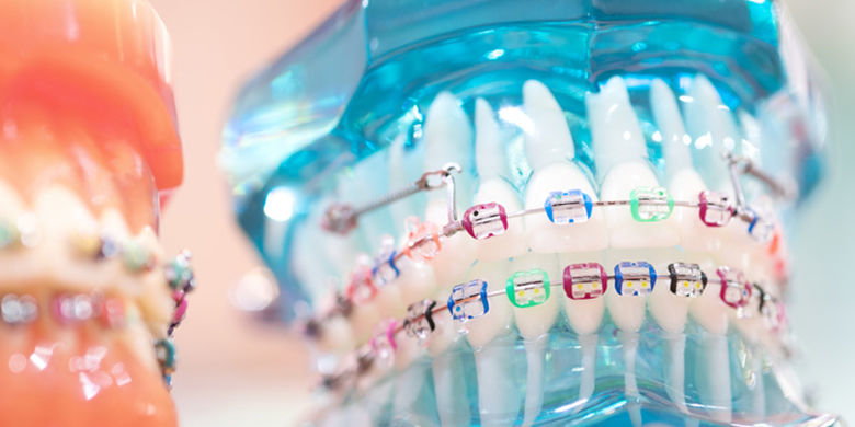 Le brackets sono il metodo di correzione più comunemente usato e vengono utilizzate per posizionare i denti dopo qualsiasi stiramento o spostamento della mascella. Le brackets sono fissate saldamente ai denti (all'esterno o all'interno) e sono usurate fino alla fine della correzione.