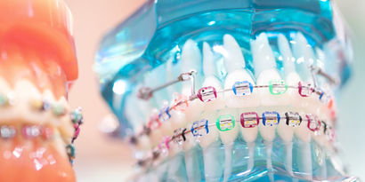Welche Zahnspangen gibt es? Kieferorthopäden beraten Sie umfassend über die zur Auswahl stehenden Verfahren. Sie geben Ihnen die optimale Empfehlung ab, welche Methoden für die anstehende Zahnstellungskorrektur zur Verfügung stehen. Dies sind die verbreitesten Spangenmodelle in der Schweiz. Brackets, 