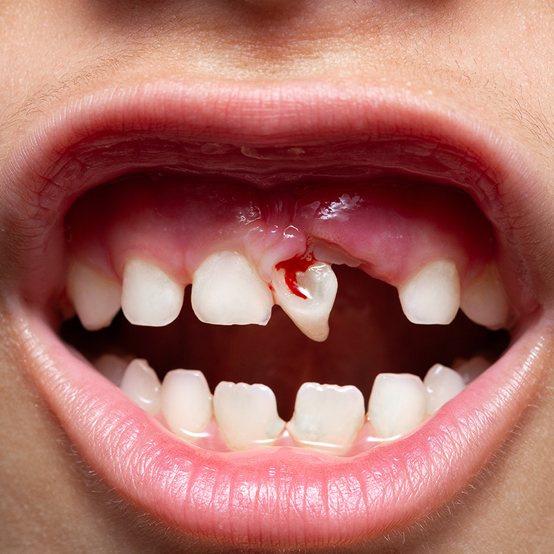 Gros plan d’une bouche ouverte avec un espace entre les dents et une blessure saignante sur les gencives. Les dents environnantes sont visibles, indiquant un accident dentaire récent.