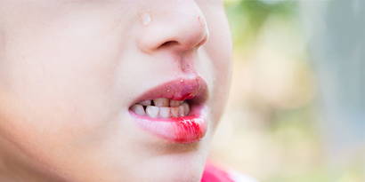 Zahnunfall bei Kindern - was ist zu tun? Wer zahlt die Untersuchung und das Zahnschadenformular und wer kommt für allfällige Folgeschäden auf? Wann muss schnellstmöglicht ein Zahnarzt aufgesucht werden? Welche Art von Zahnunfällen gibt es und was ist das richtige Verhalten bei welcher Art von Unfall?